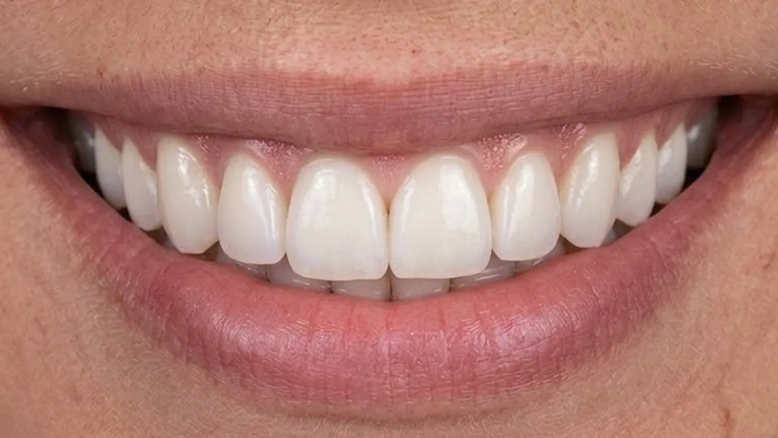 Adult Braces - After