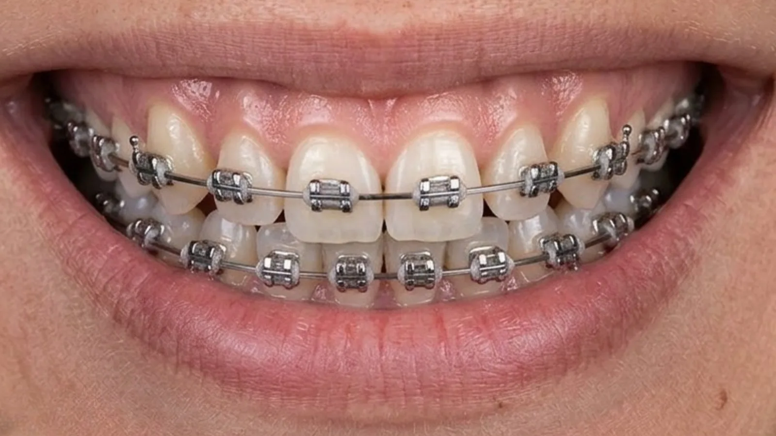 Adult Braces - Before
