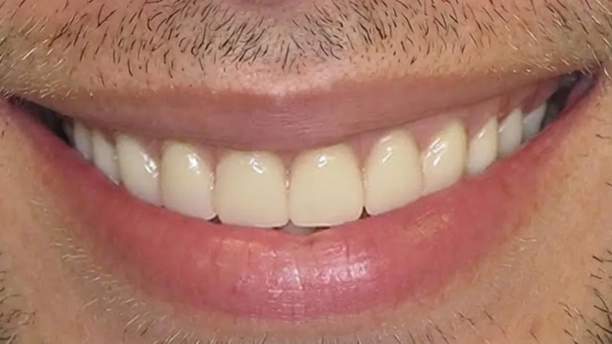 Full Smile Makeover - After