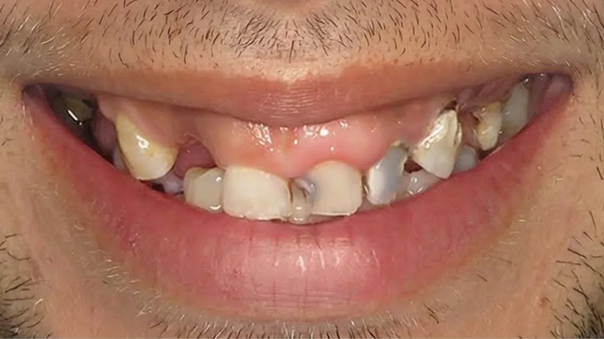 Full Smile Makeover - Before