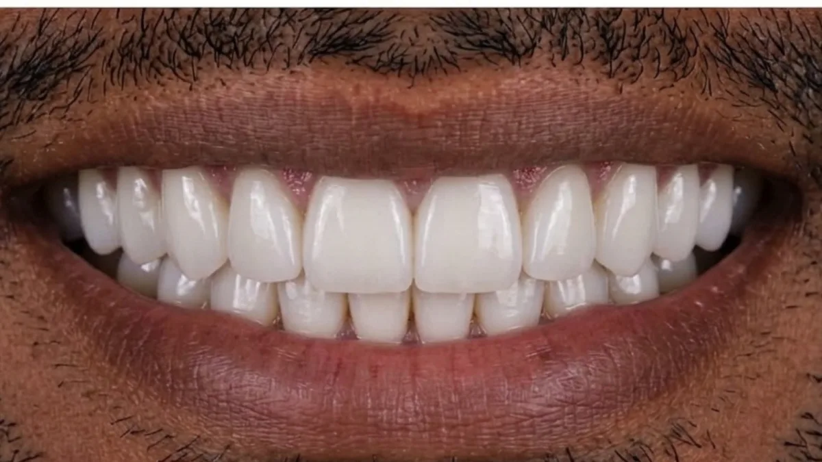 Smile Transformation - After