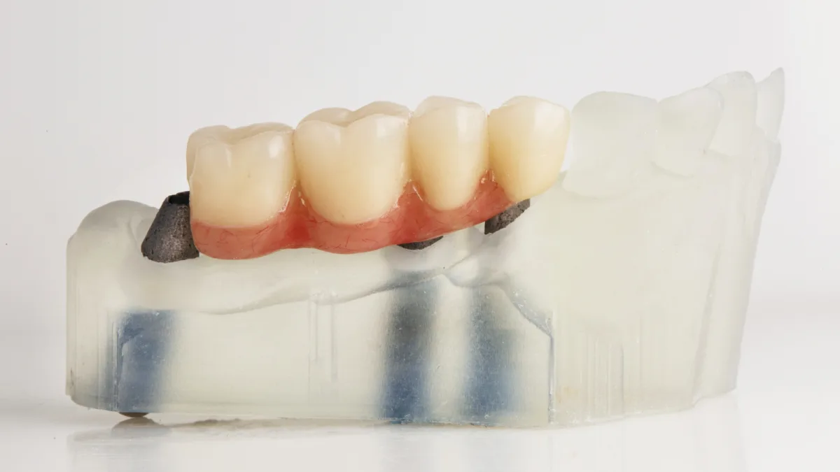 Dental Bridges