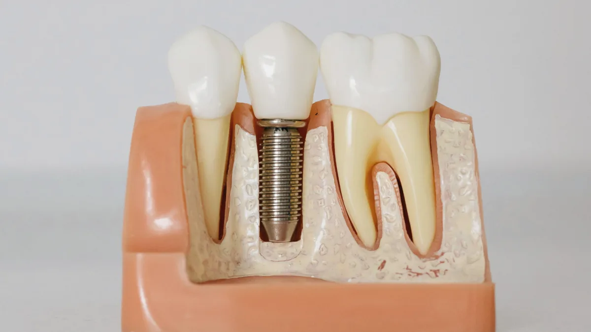 Dental Implants