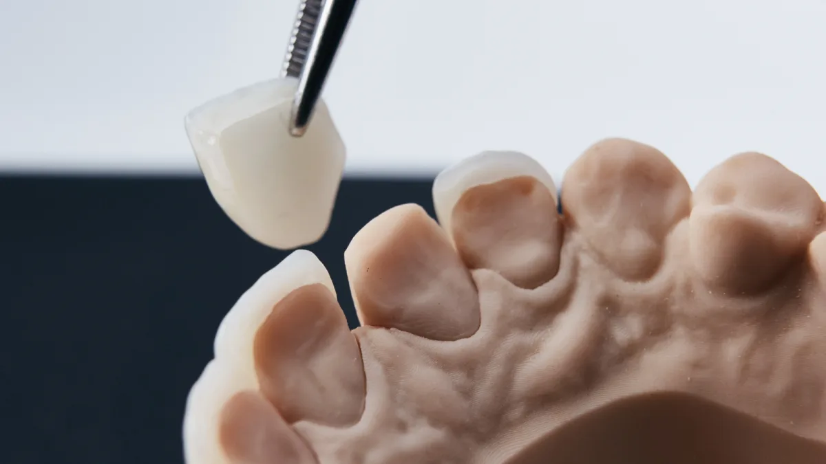 Veneers