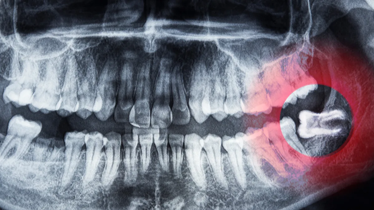 Wisdom Tooth Extraction